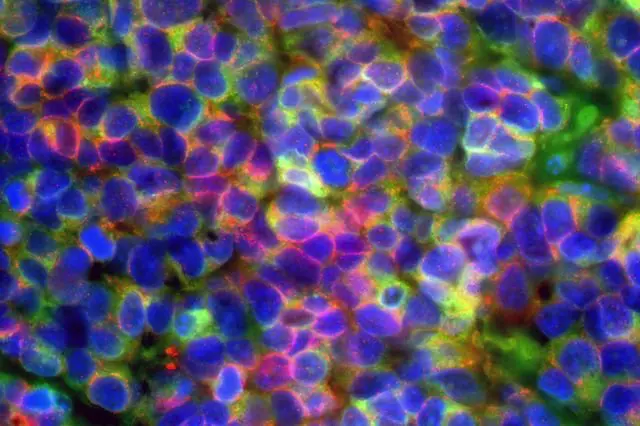 Aggressive prostate and lung cancers are driven by common mechanisms, researchers find